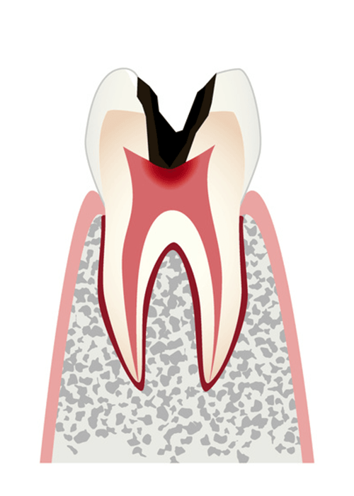 歯髄(神経)まで進行した虫歯